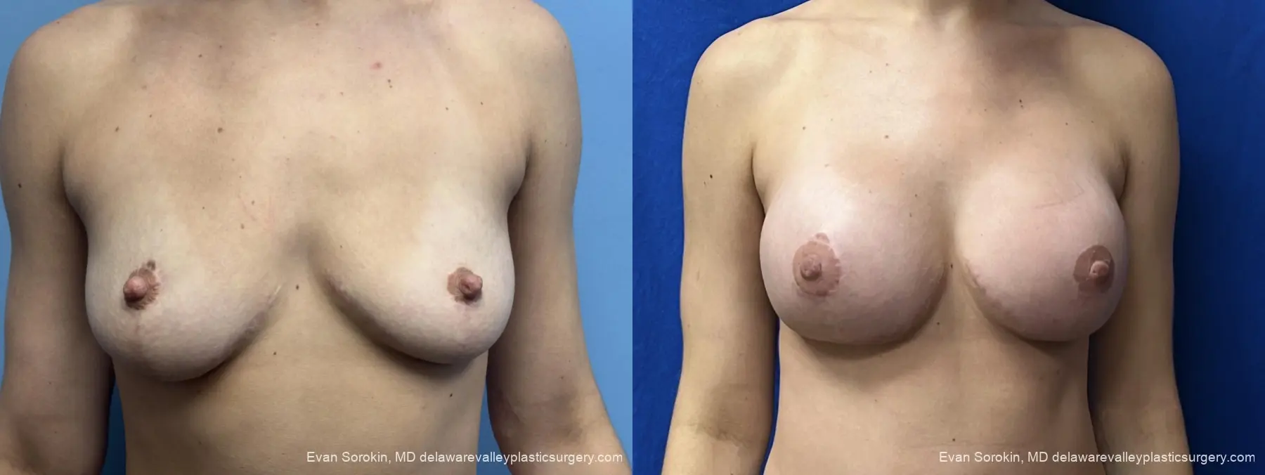 Breast Augmentation: Patient 310 - Before and After 1