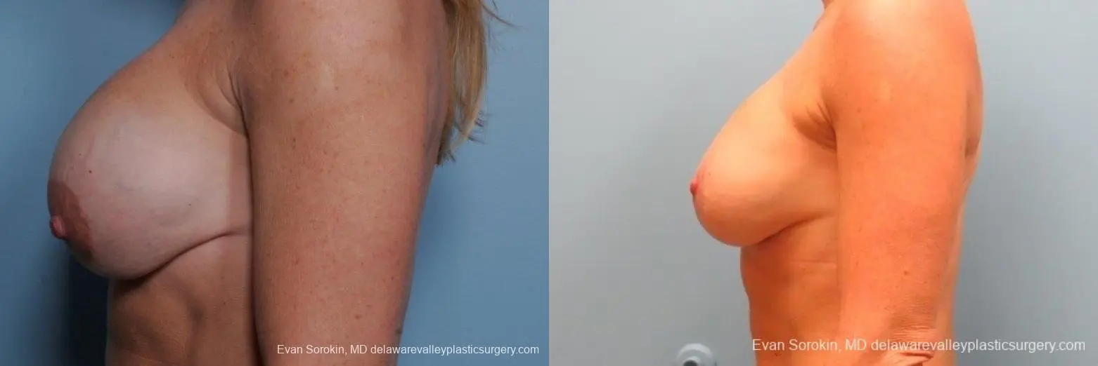 Philadelphia Breast Augmentation 8693 - Before and After 5