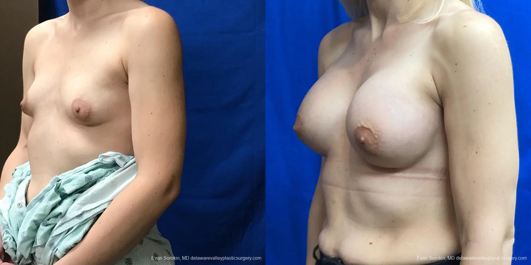 Breast Augmentation: Patient 221 - Before and After 4