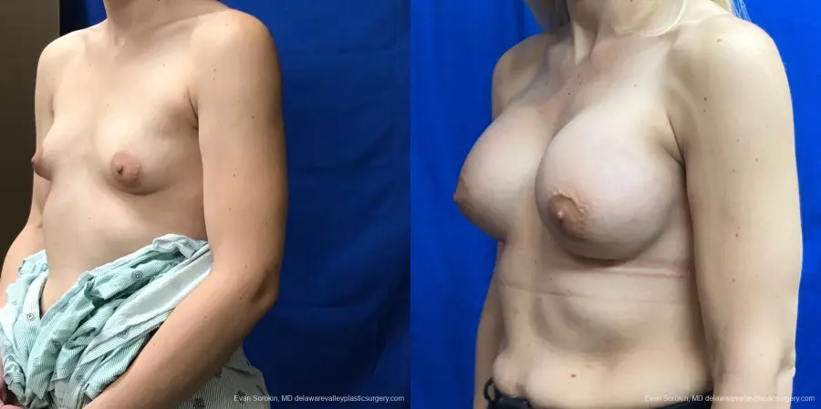 Breast Augmentation: Patient 192 - Before and After 4