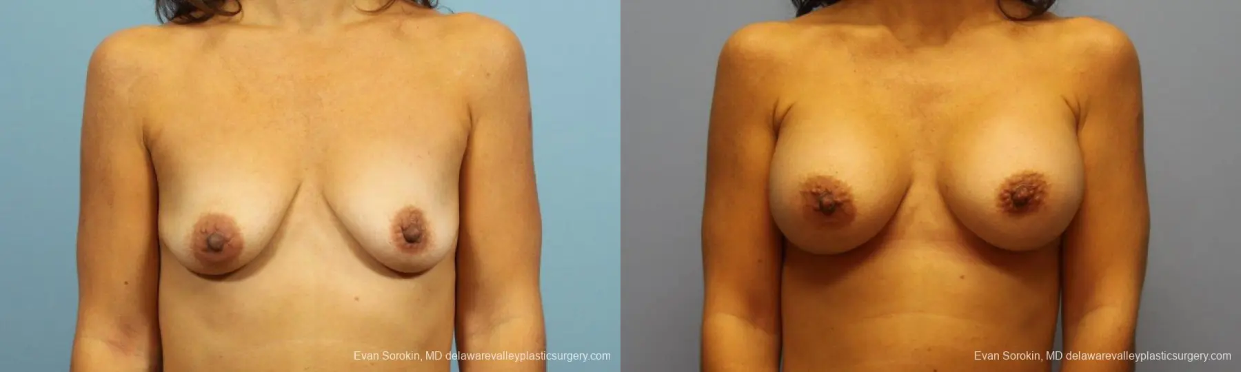 Philadelphia Breast Augmentation 9422 - Before and After 1