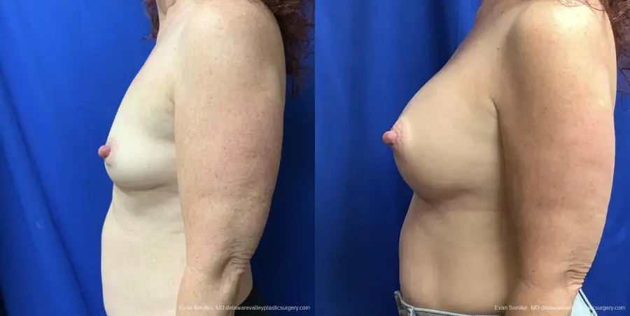 Breast Augmentation: Patient 176 - Before and After 5