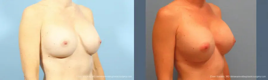 Philadelphia Breast Augmentation 9456 - Before and After 2