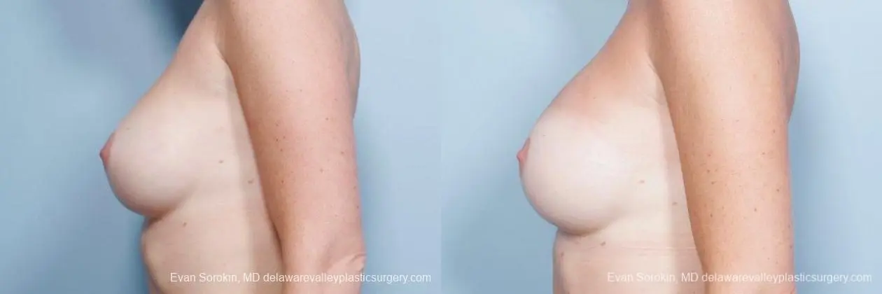 Philadelphia Breast Augmentation 9402 - Before and After 5