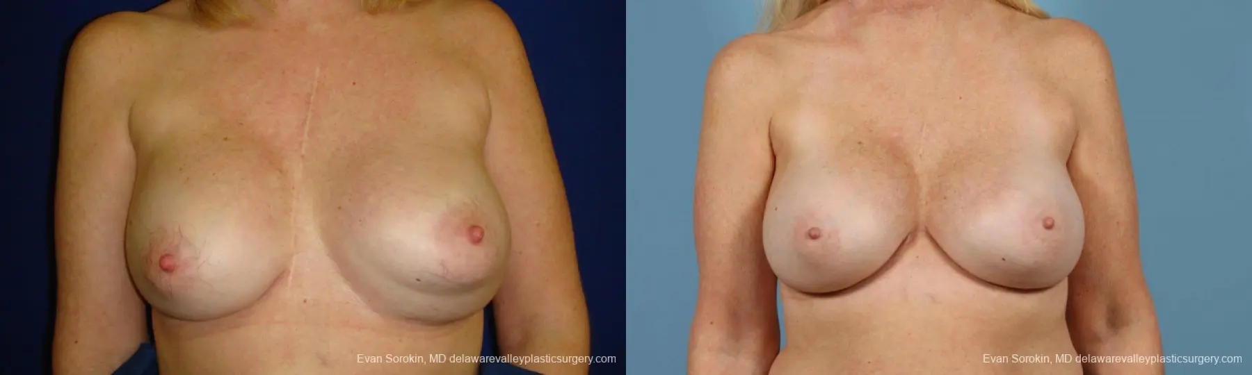 Philadelphia Breast Augmentation 9457 - Before and After 1