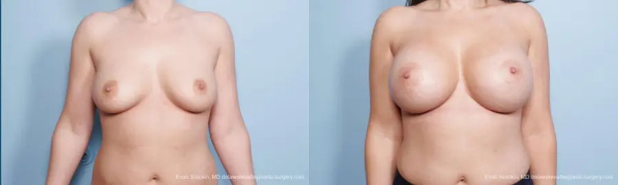 Philadelphia Breast Augmentation 9172 - Before and After 1