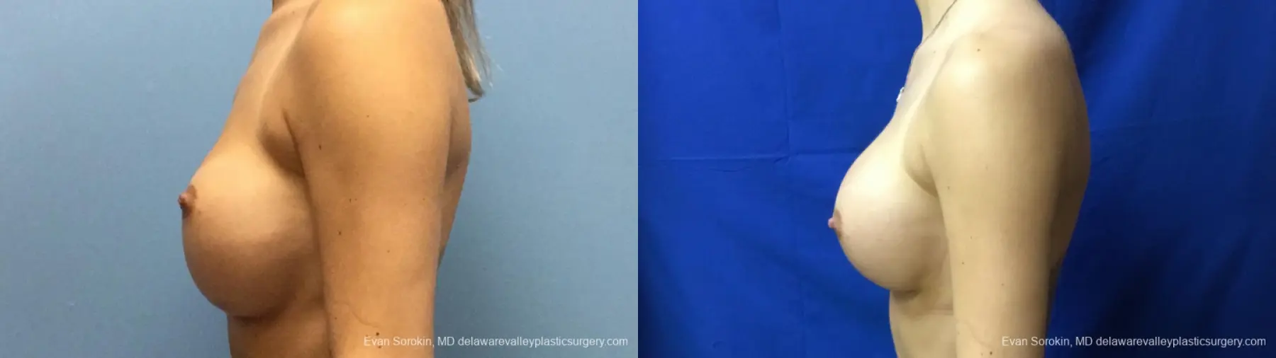 Philadelphia Breast Augmentation 13177 - Before and After 5