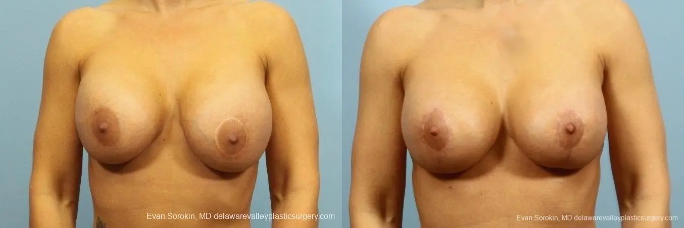 Philadelphia Breast Augmentation 8709 - Before and After 1