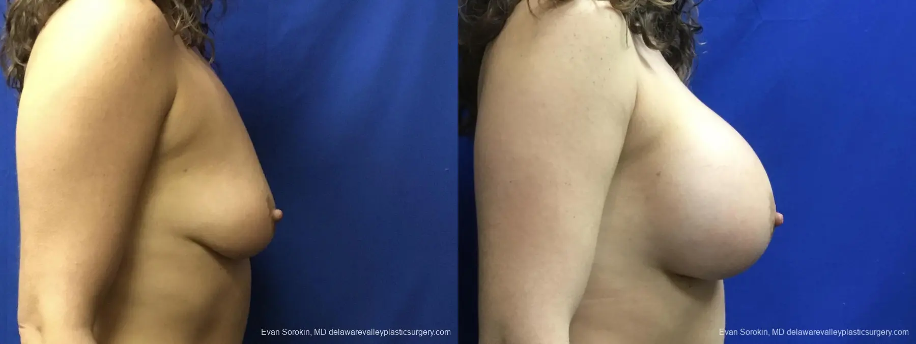 Breast Augmentation: Patient 241 - Before and After 3