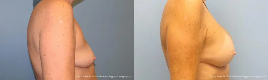 Philadelphia Breast Augmentation 9600 - Before and After 3