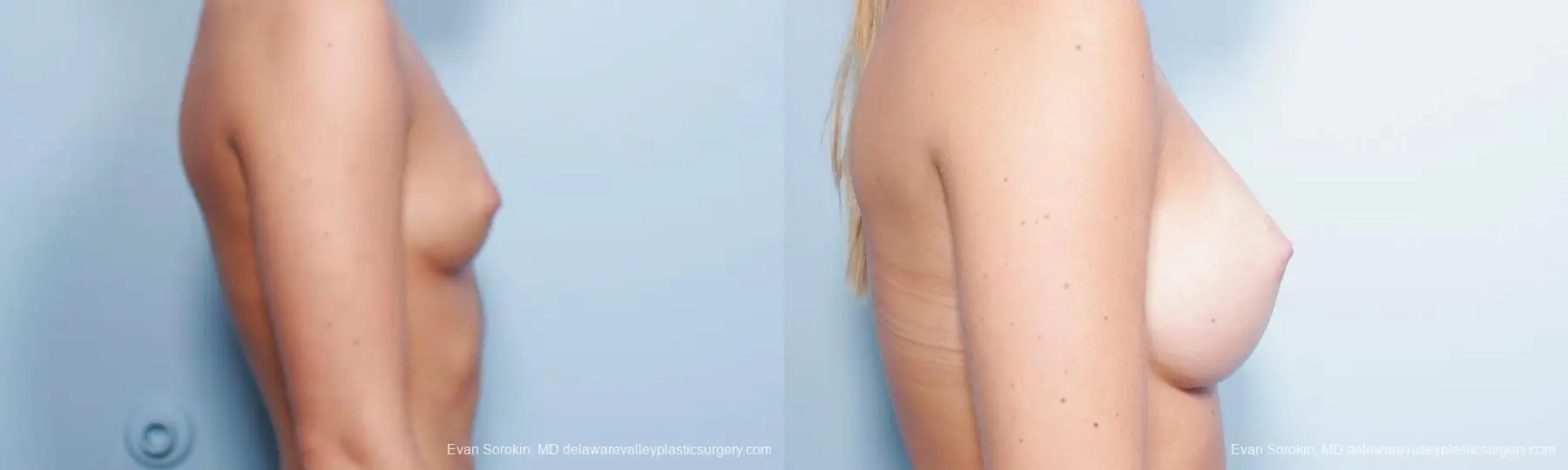 Philadelphia Breast Augmentation 9304 - Before and After 3