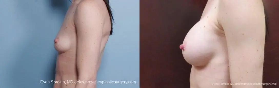Philadelphia Breast Augmentation 9107 - Before and After 5