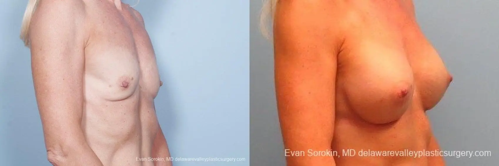 Philadelphia Breast Augmentation 8770 - Before and After 2