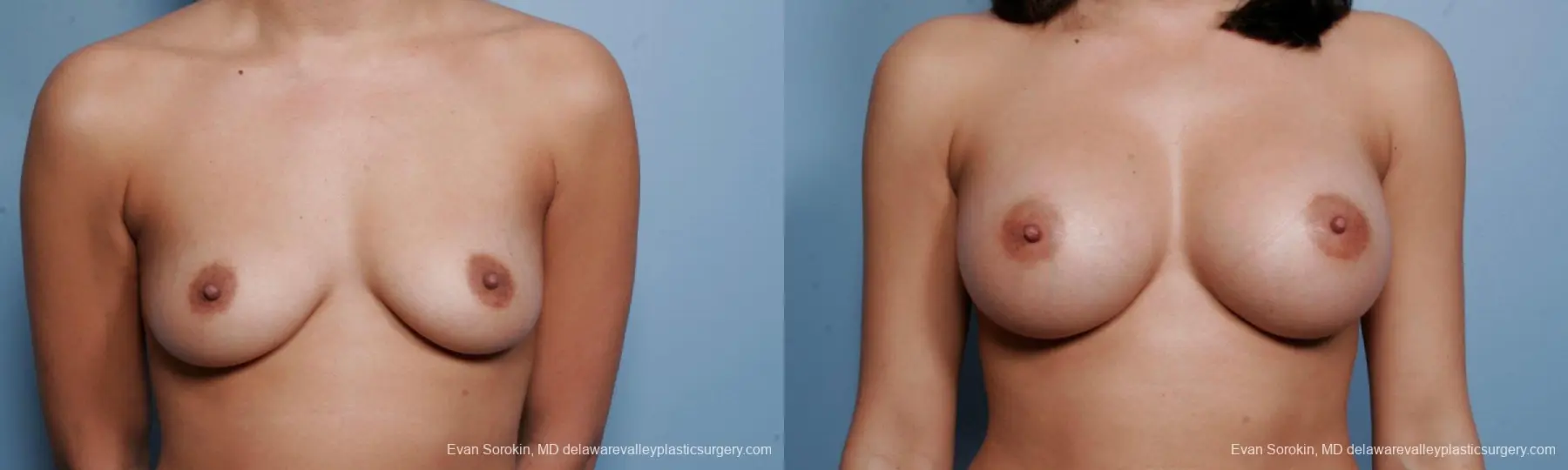 Philadelphia Breast Augmentation 9373 - Before and After 1