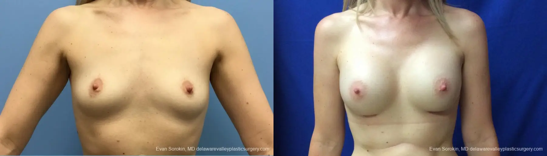 Philadelphia Breast Augmentation 12520 - Before and After 1