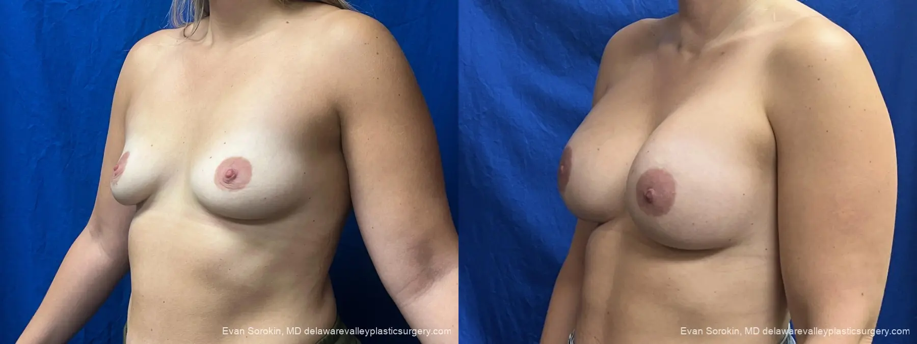 Breast Augmentation: Patient 326 - Before and After 4