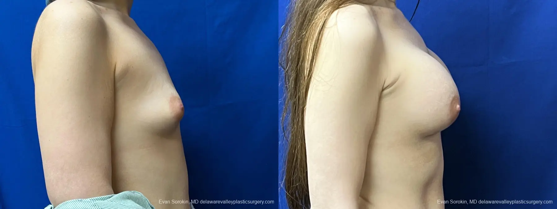 Breast Augmentation: Patient 205 - Before and After 3