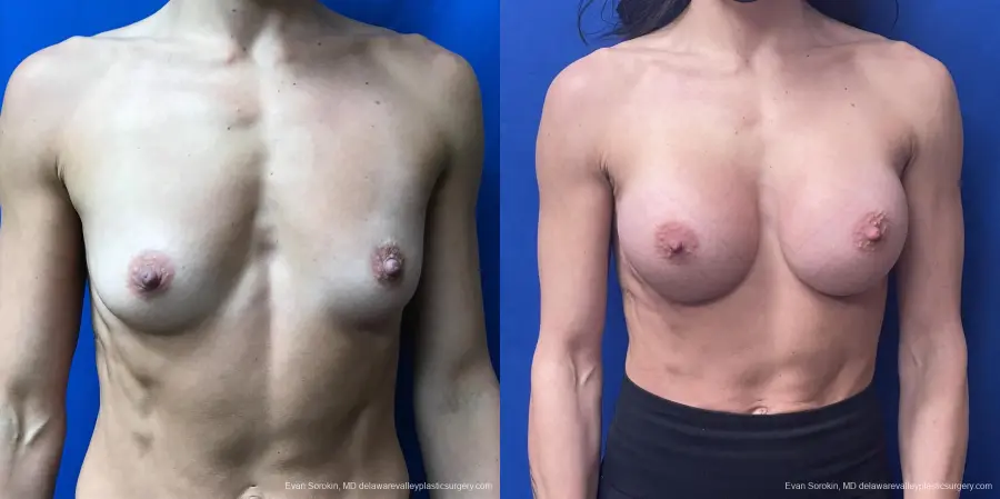 Breast Augmentation: Patient 218 - Before and After 1