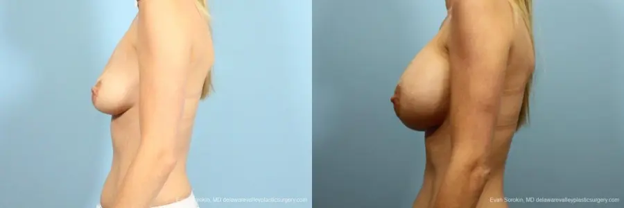 Philadelphia Breast Augmentation 9105 - Before and After 5
