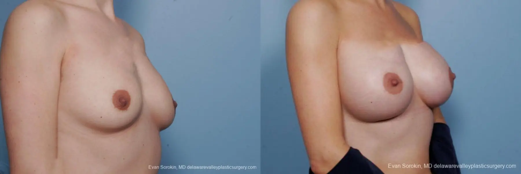 Philadelphia Breast Augmentation 9385 - Before and After 2