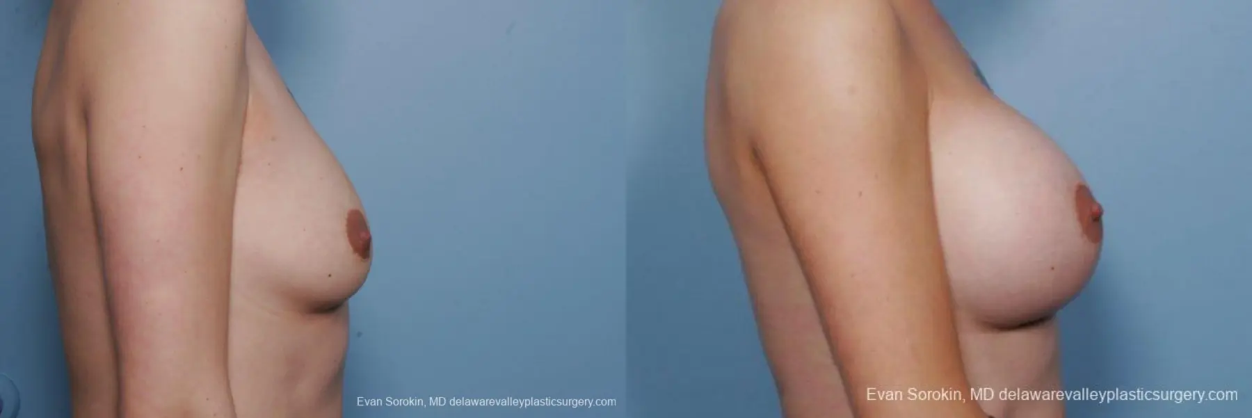Philadelphia Breast Augmentation 9385 - Before and After 3