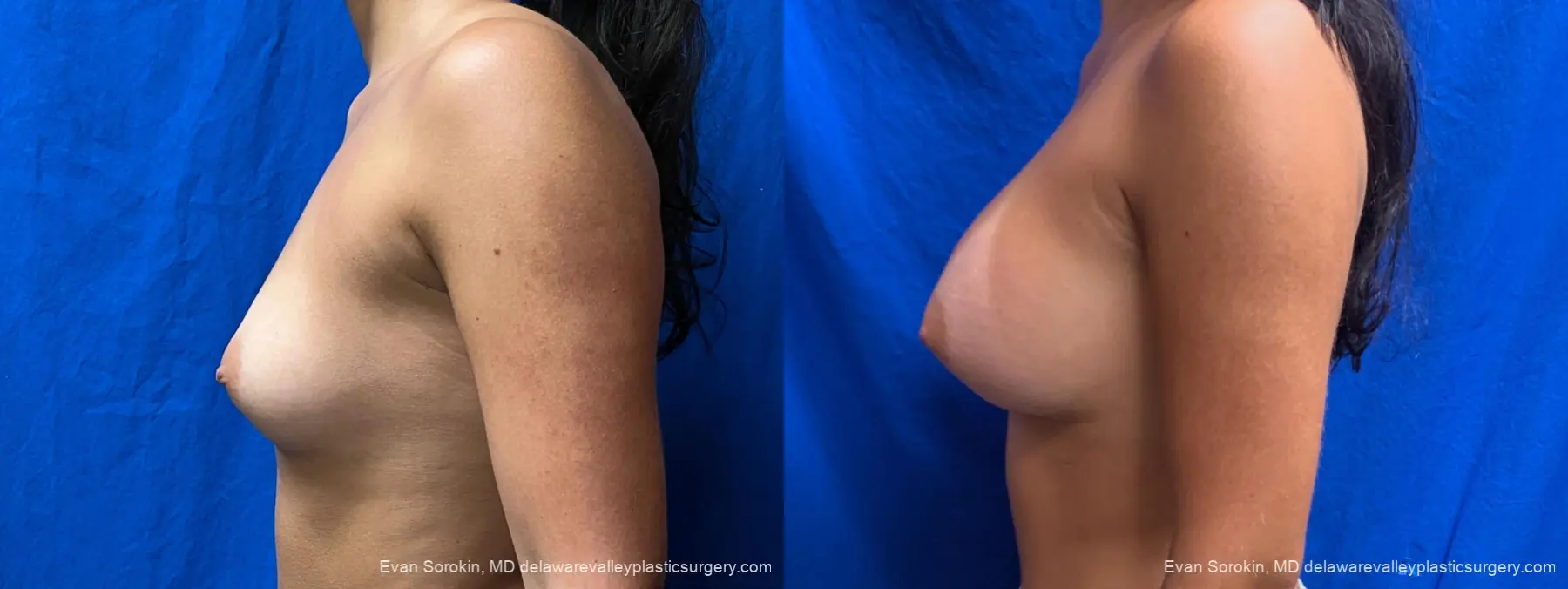 Breast Augmentation: Patient 314 - Before and After 5