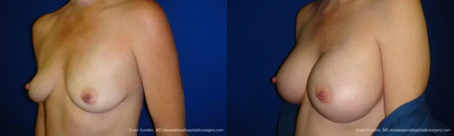 Philadelphia Breast Augmentation 9295 - Before and After 4