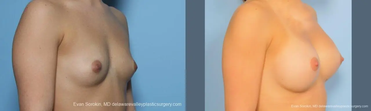 Philadelphia Breast Augmentation 8773 - Before and After 2