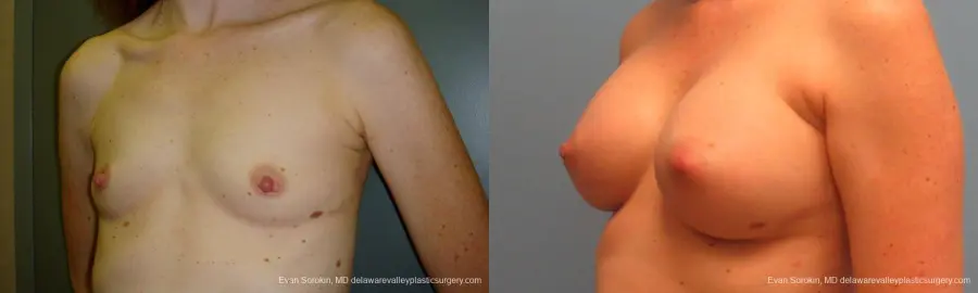 Philadelphia Breast Augmentation 9180 - Before and After 4