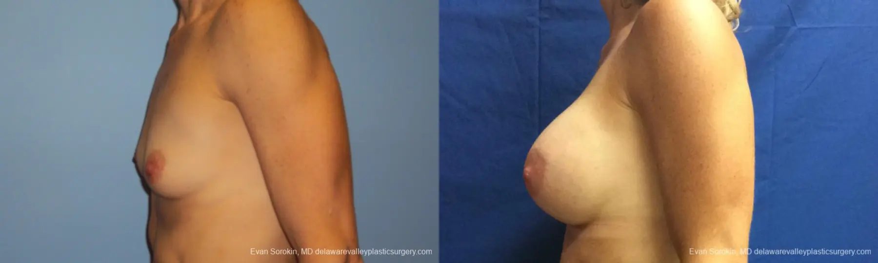 Philadelphia Breast Augmentation 10248 - Before and After 5