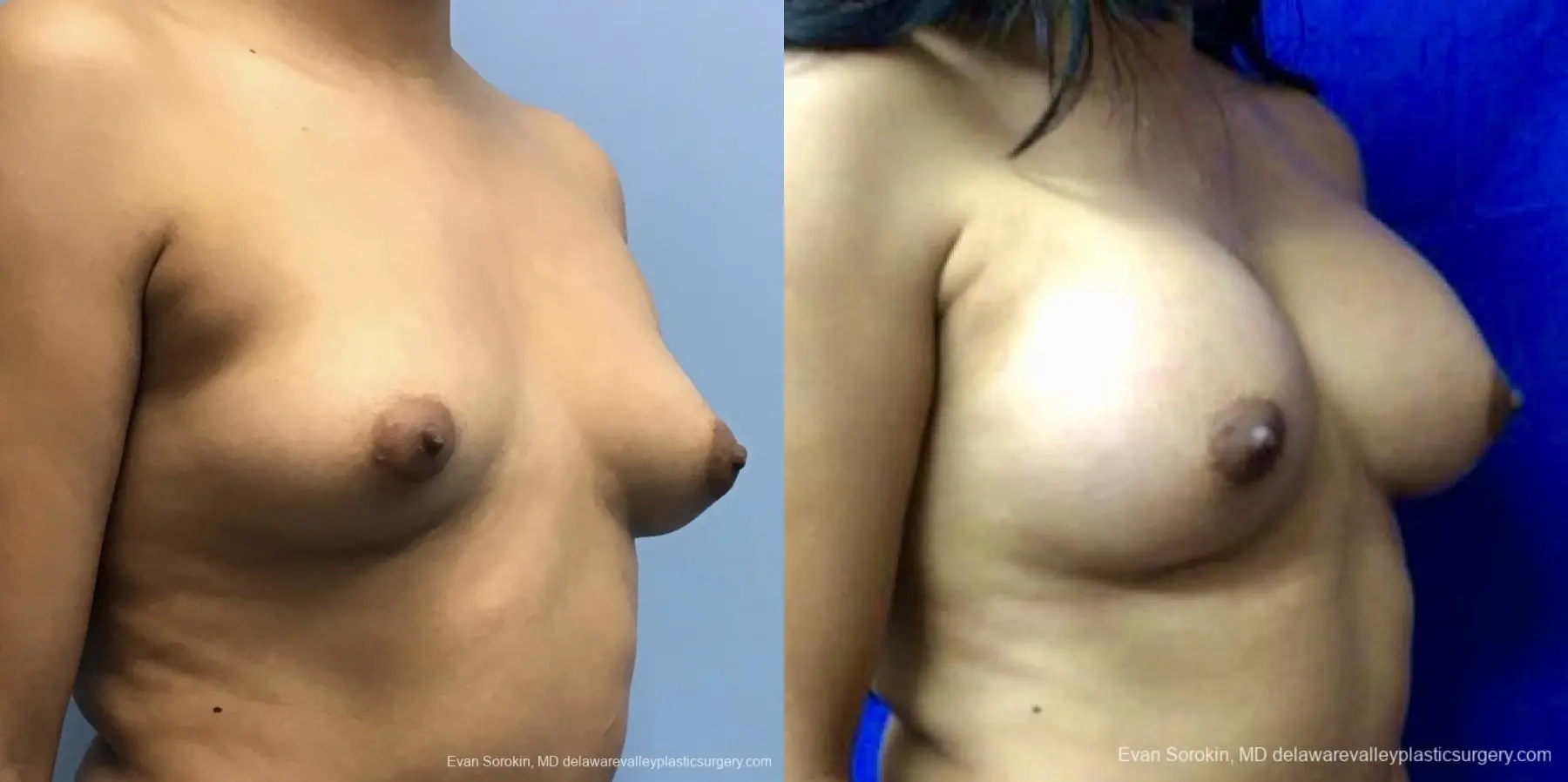 Breast Augmentation: Patient 192 - Before and After 2