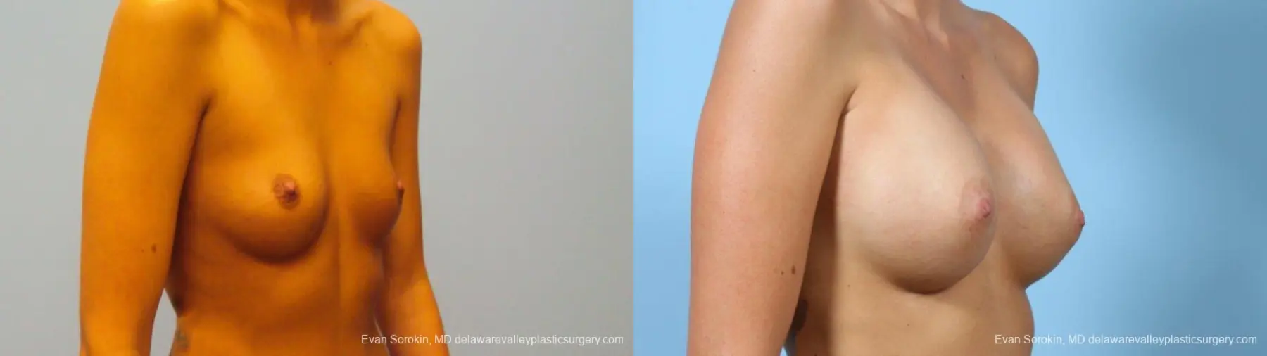 Philadelphia Breast Augmentation 9292 - Before and After 2