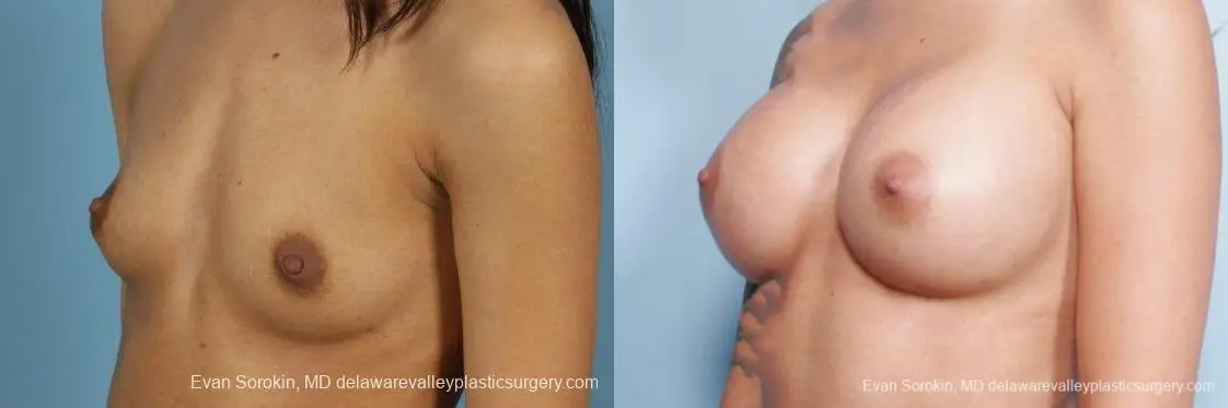 Philadelphia Breast Augmentation 9411 - Before and After 2