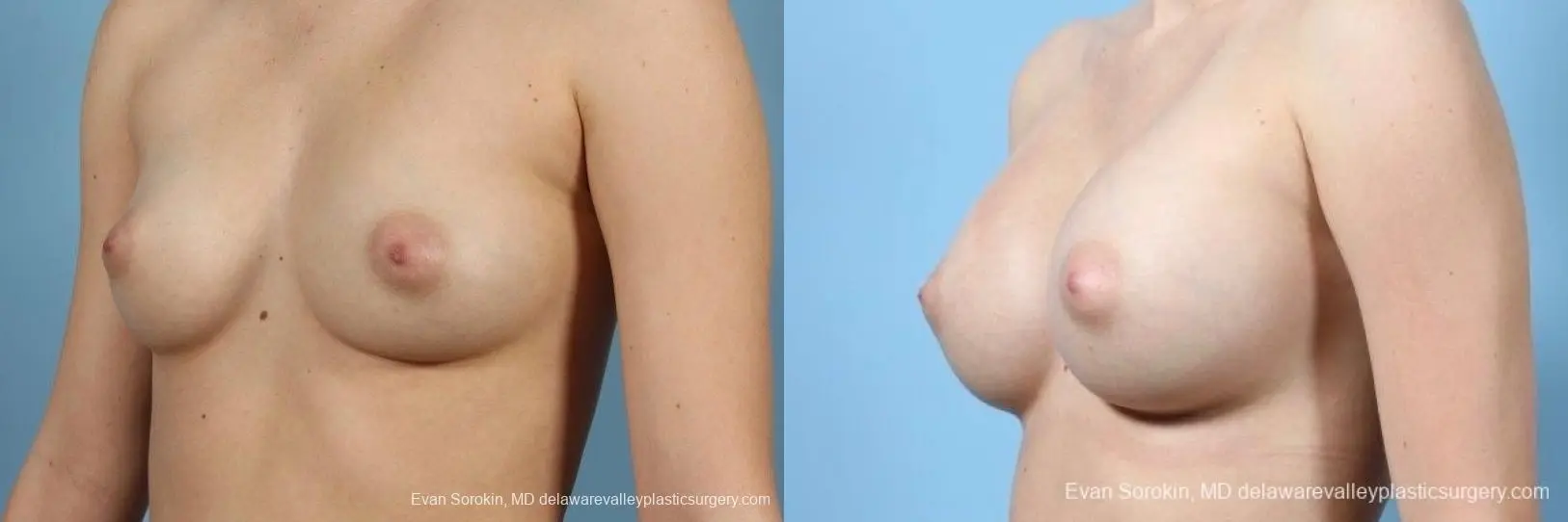 Philadelphia Breast Augmentation 8766 - Before and After 3