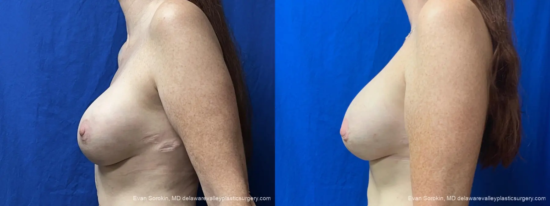 Breast Augmentation: Patient 299 - Before and After 5