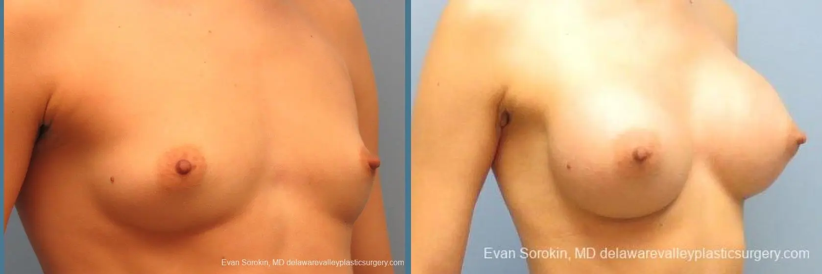 Philadelphia Breast Augmentation 10097 - Before and After 2