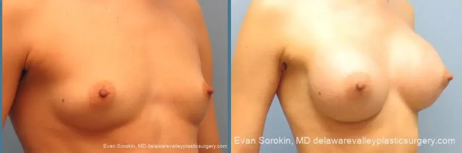 Philadelphia Breast Augmentation 10097 - Before and After 2