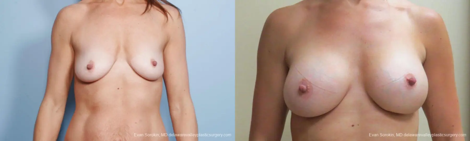 Philadelphia Breast Augmentation 9174 - Before and After 1