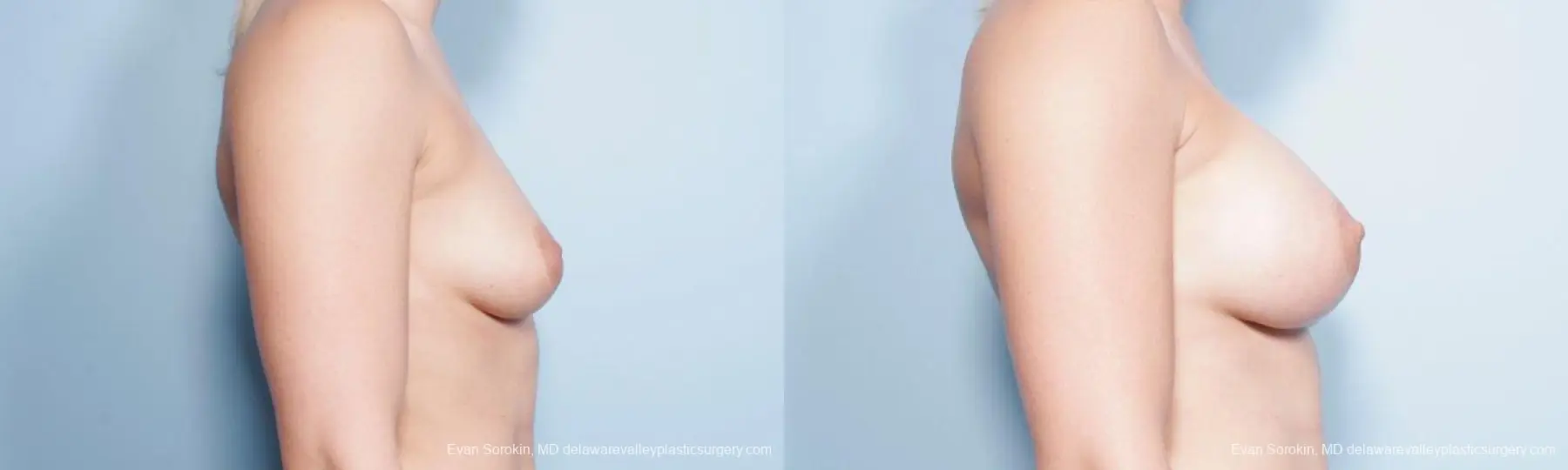 Philadelphia Breast Augmentation 9296 - Before and After 3