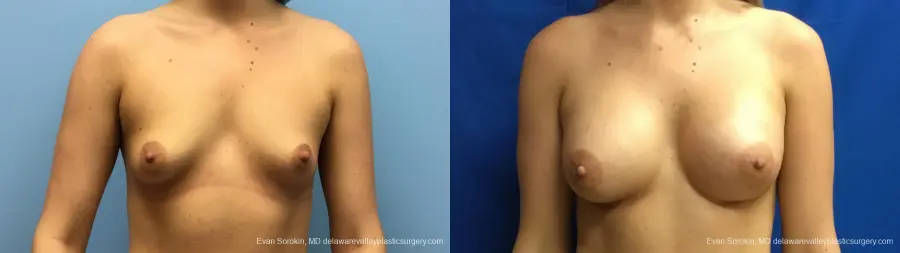 Philadelphia Breast Augmentation 12540 - Before and After 1