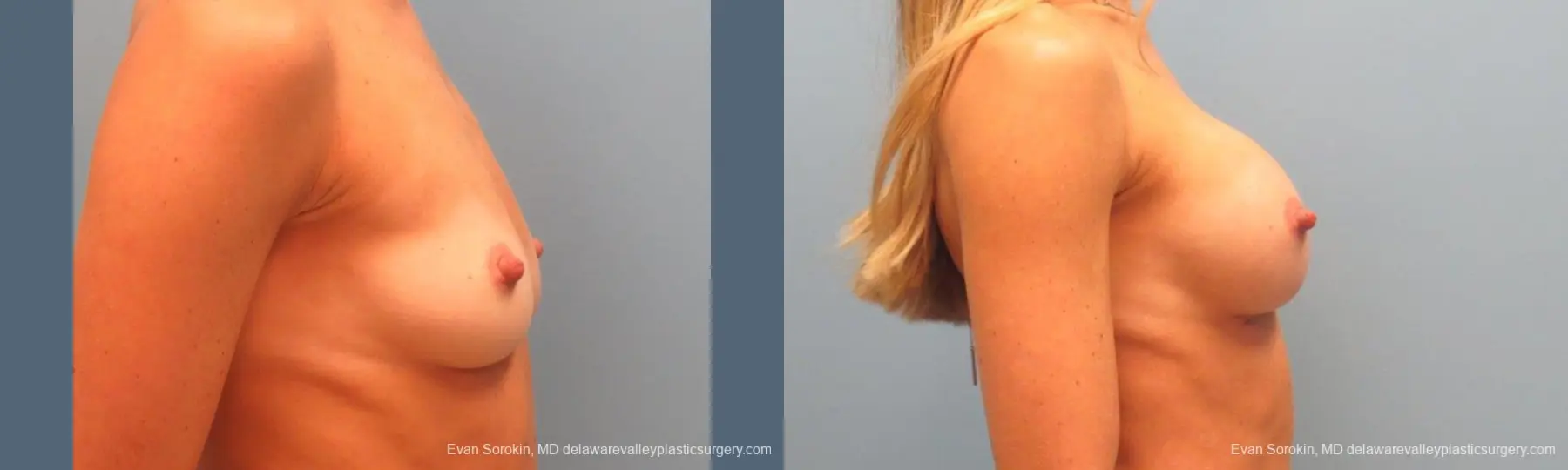 Philadelphia Breast Augmentation 9396 - Before and After 3