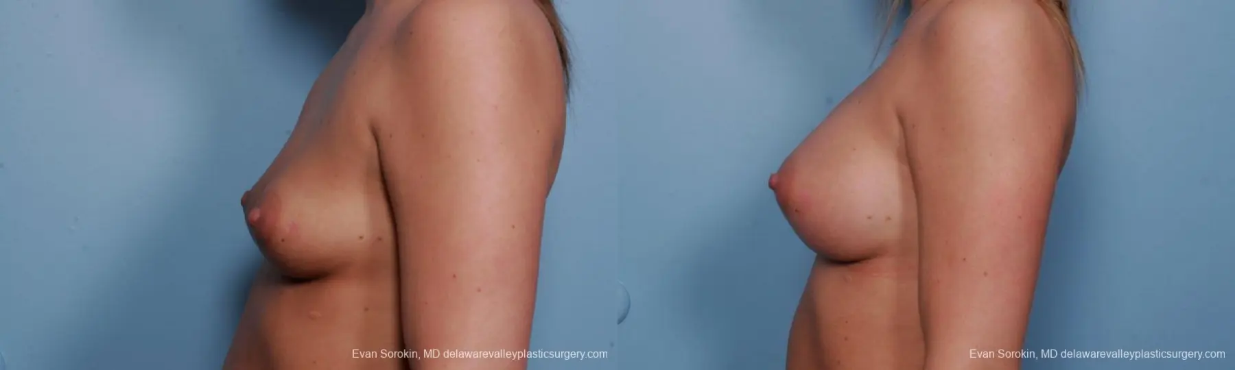 Philadelphia Breast Augmentation 9379 - Before and After 4