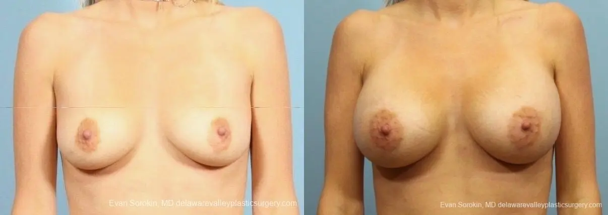 Philadelphia Breast Augmentation 8782 - Before and After 1