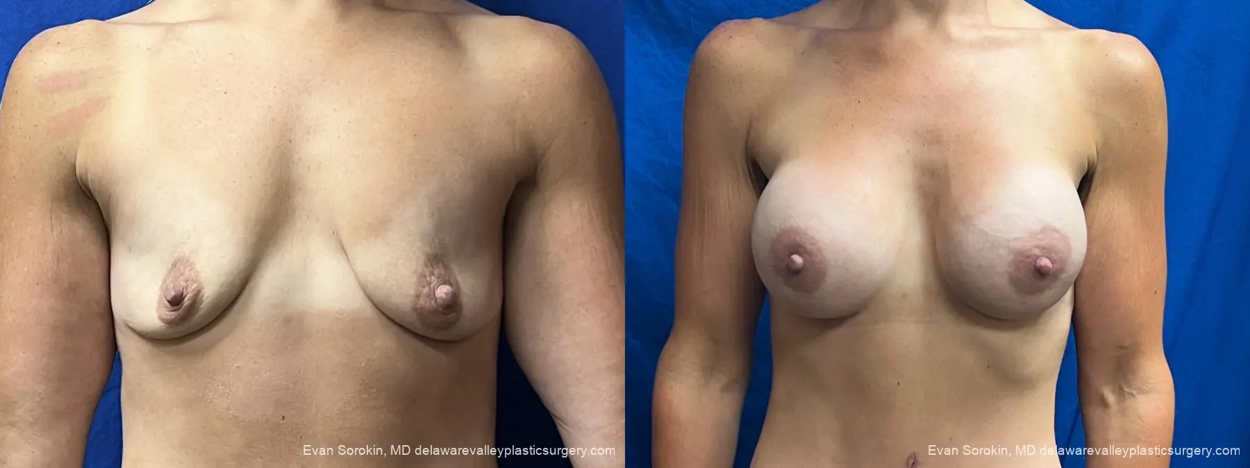 Breast Augmentation: Patient 305 - Before and After 1