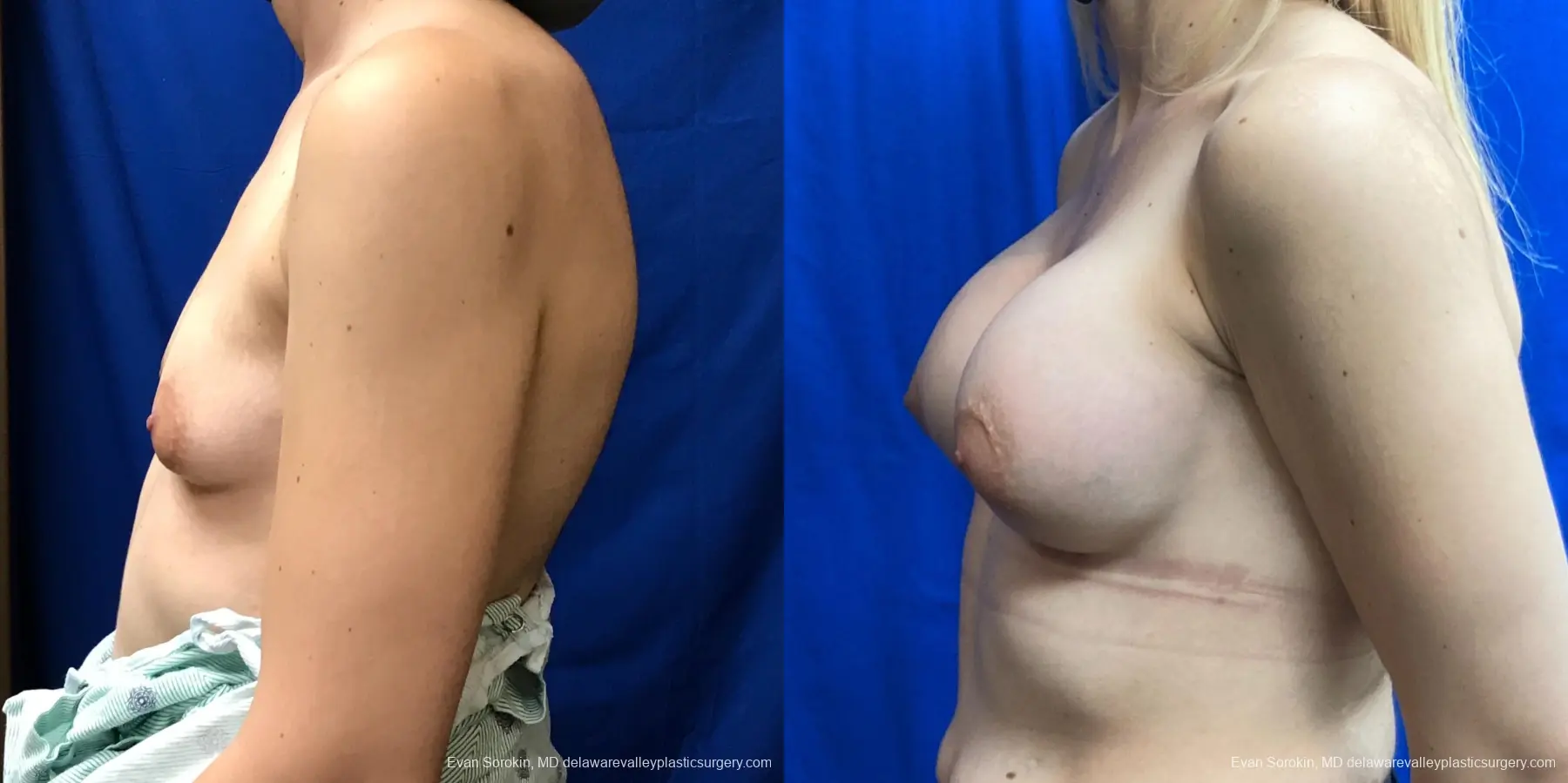 Breast Augmentation: Patient 192 - Before and After 5