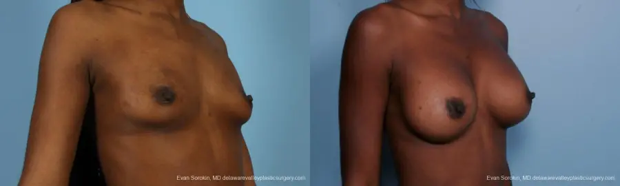 Philadelphia Breast Augmentation 8655 - Before and After 2
