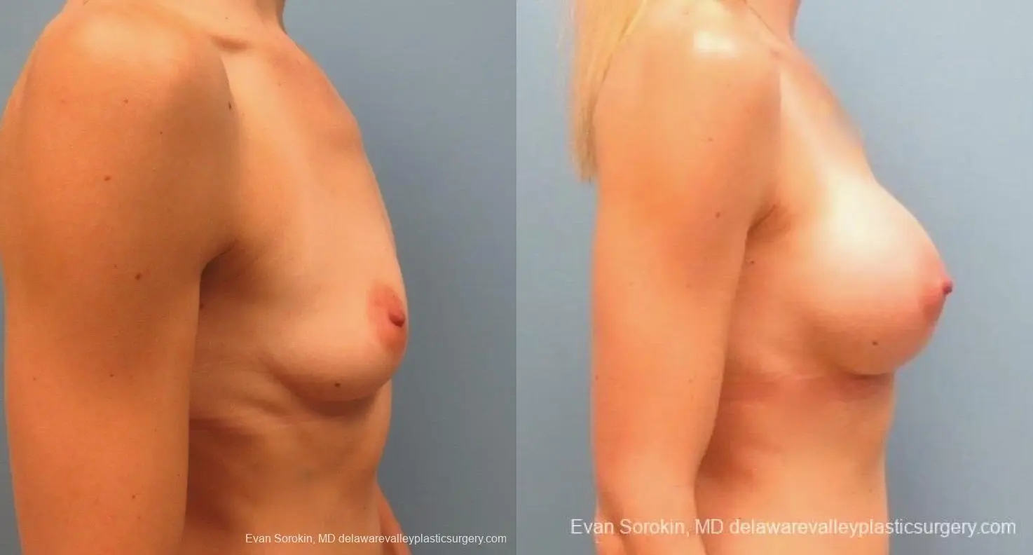Philadelphia Breast Augmentation 8823 - Before and After 4