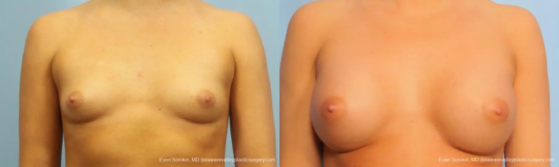 Philadelphia Breast Augmentation 9183 - Before and After 1