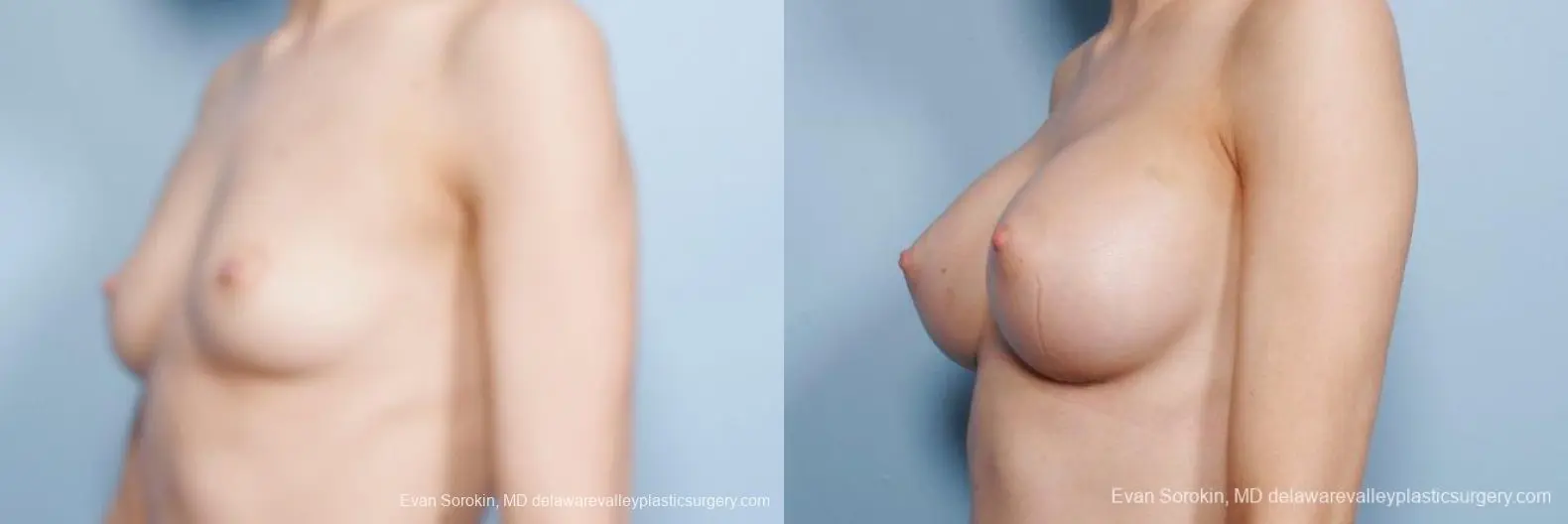Philadelphia Breast Augmentation 8663 - Before and After 3