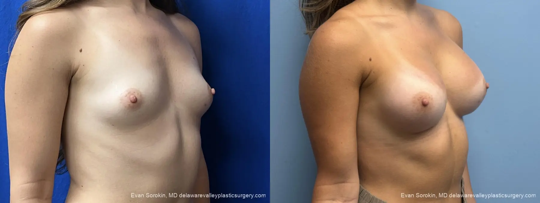 Breast Augmentation: Patient 3 - Before and After 2